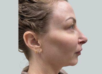Rhinoplasty before at Studio Esthetique Skin & Laser Center NYC in New York, NY