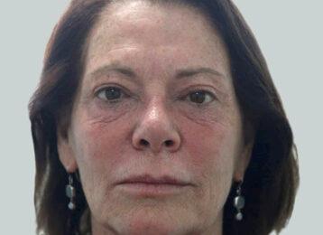 Studio Esthetique Skin & Laser Center NYC botox after — New York, NY