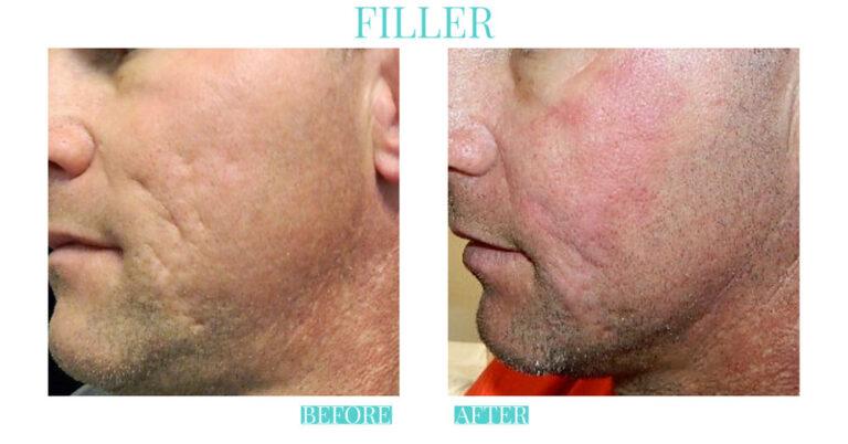 Bliss Medical Spa result — Oklahoma City, OK