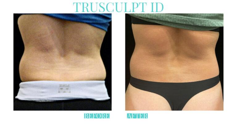 Bliss Medical Spa result — Oklahoma City, OK
