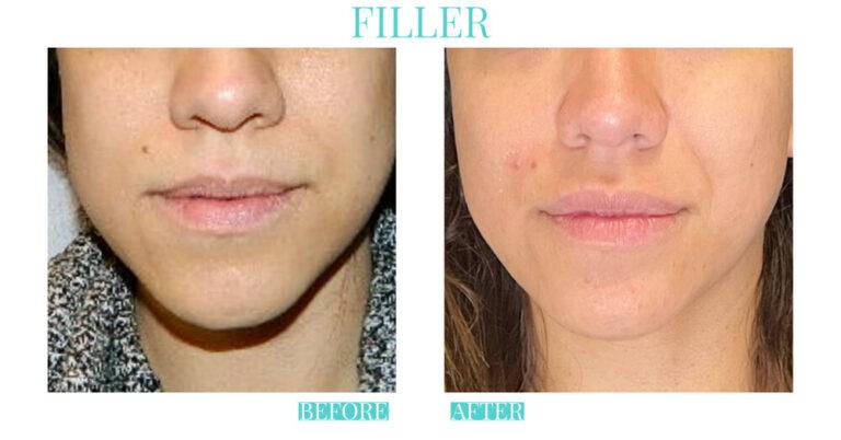 Bliss Medical Spa result — Oklahoma City, OK