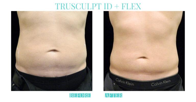 Bliss Medical Spa result — Oklahoma City, OK