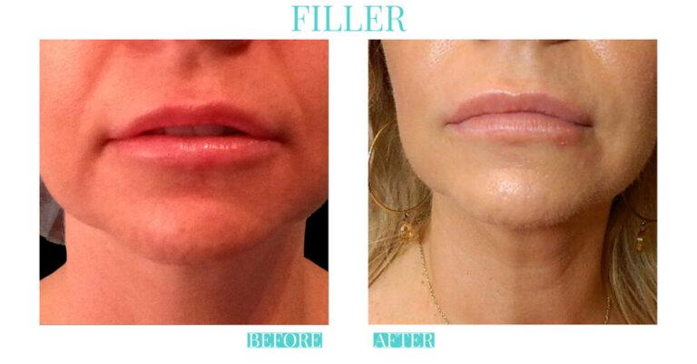 Bliss Medical Spa result — Oklahoma City, OK