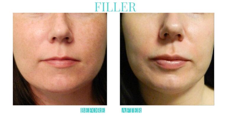 Bliss Medical Spa result — Oklahoma City, OK