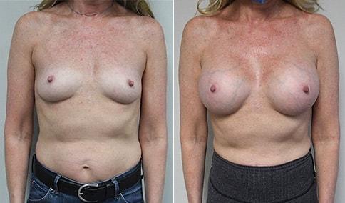 Jonathan Hall, MD breast augmentation result — Stoneham, MA