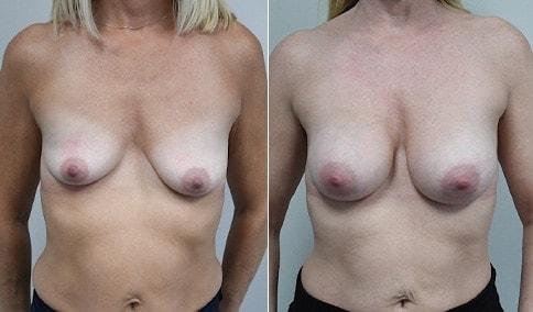 Jonathan Hall, MD breast augmentation result — Stoneham, MA