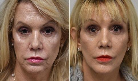 Jonathan Hall, MD facelift result — Stoneham, MA