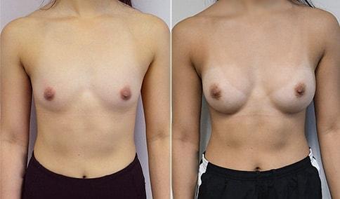 Jonathan Hall, MD breast augmentation result — Stoneham, MA