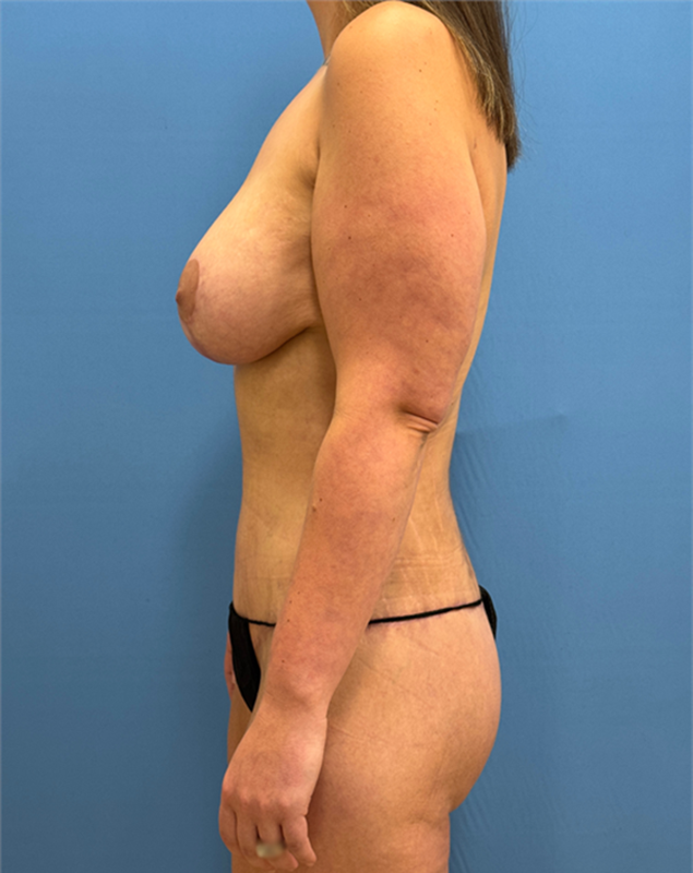 Mommy Makeover after at Clareo Plastic Surgery in Chestnut Hill, MA