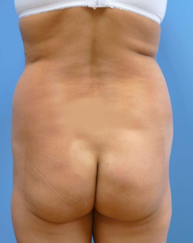 Brazilian Butt Lift before at Clareo Plastic Surgery in Newton, MA