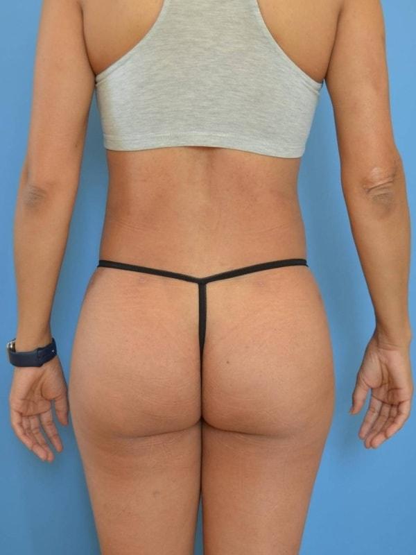 Brazilian Butt Lift after at Clareo Plastic Surgery in Newton, MA