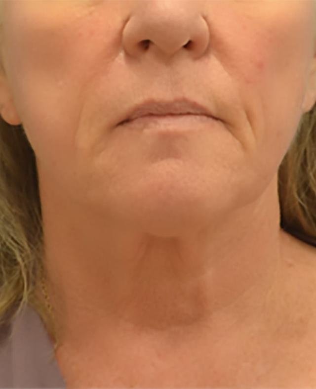 Mini Facelift before at Clareo Plastic Surgery in Newton, MA