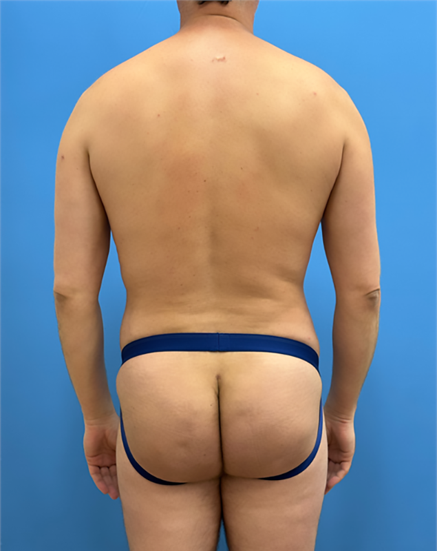 Clareo Plastic Surgery bbl after — Chestnut Hill, MA