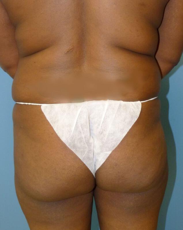 Brazilian Butt Lift before at Clareo Plastic Surgery in Newton, MA