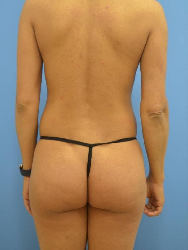 Brazilian Butt Lift before at Clareo Plastic Surgery in Newton, MA
