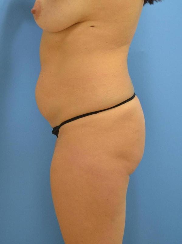 Brazilian Butt Lift before at Clareo Plastic Surgery in Newton, MA