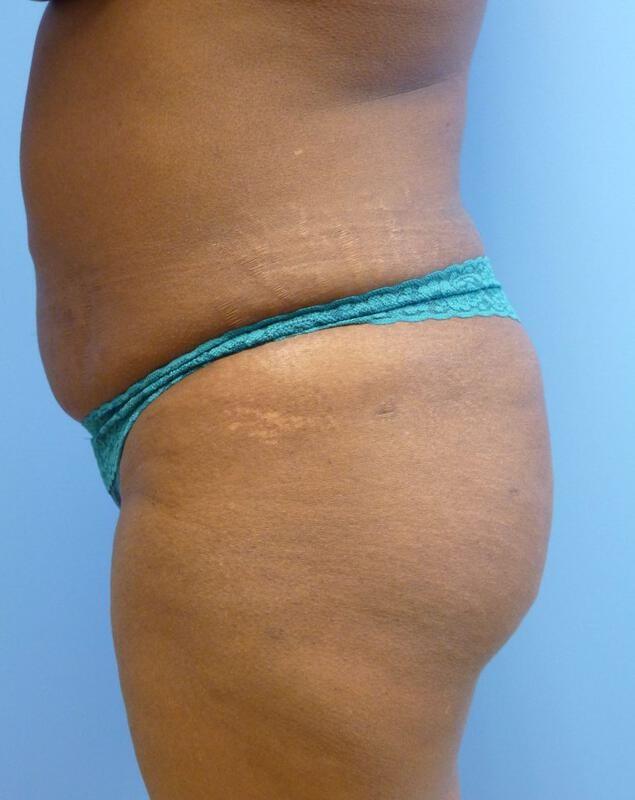 Brazilian Butt Lift after at Clareo Plastic Surgery in Newton, MA
