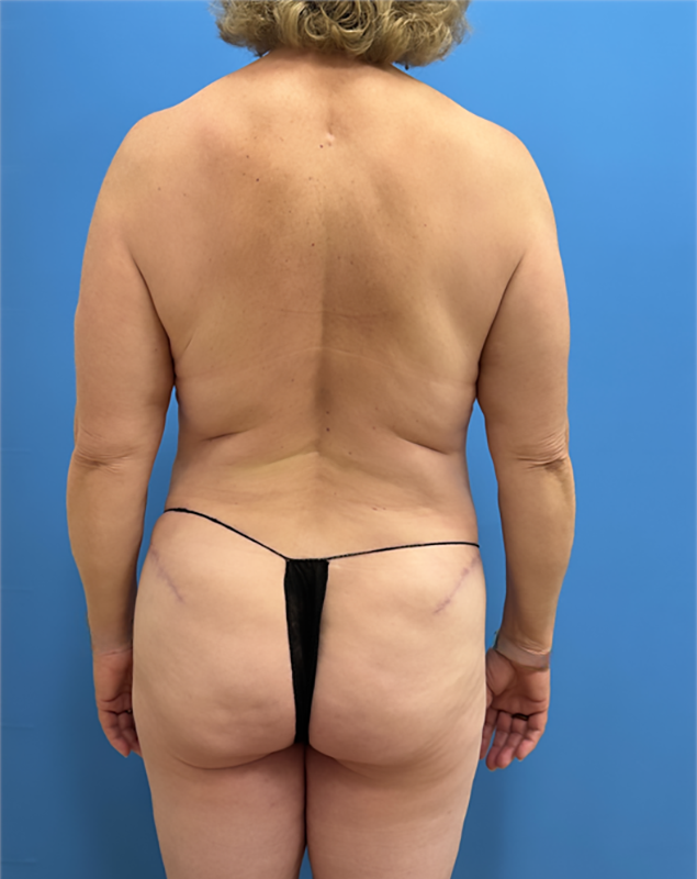 Tummy Tuck after at Clareo Plastic Surgery in Chestnut Hill, MA