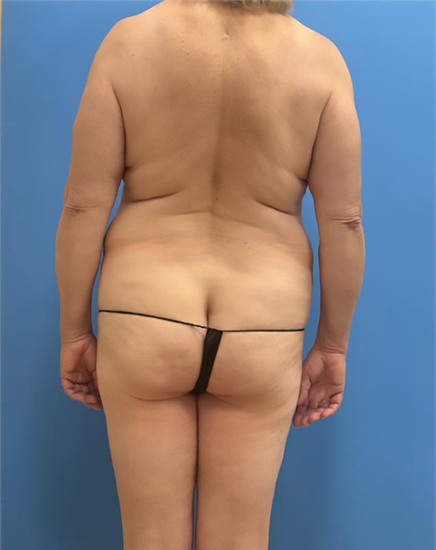 Tummy Tuck before at Clareo Plastic Surgery in Chestnut Hill, MA