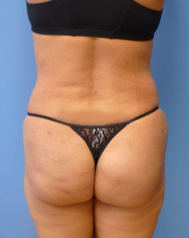 Brazilian Butt Lift after at Clareo Plastic Surgery in Newton, MA