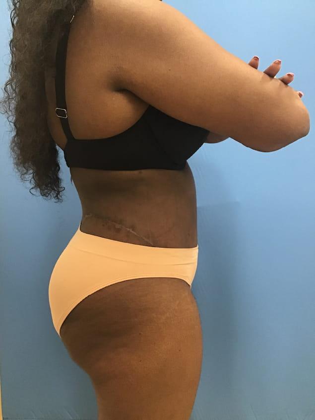 Tummy Tuck after at Clareo Plastic Surgery in Chestnut Hill, MA
