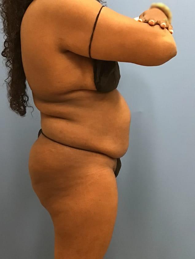 Tummy Tuck before at Clareo Plastic Surgery in Chestnut Hill, MA