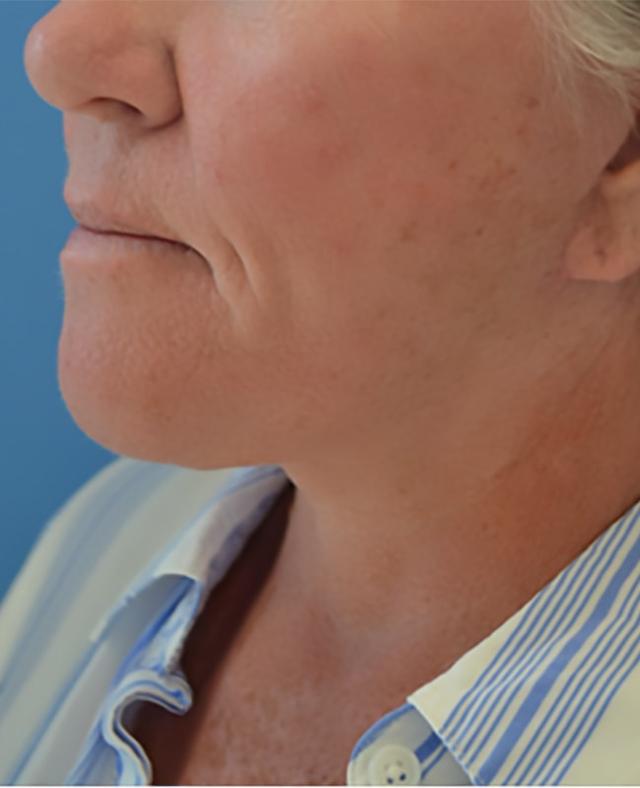 Mini Facelift after at Clareo Plastic Surgery in Newton, MA