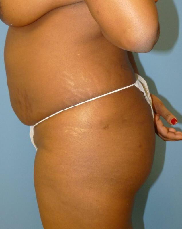 Brazilian Butt Lift before at Clareo Plastic Surgery in Newton, MA