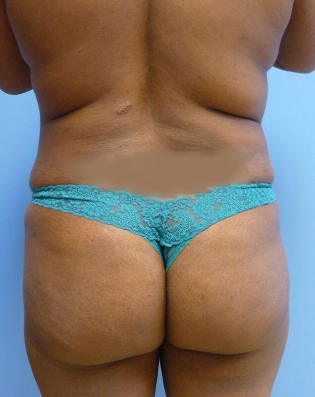 Brazilian Butt Lift after at Clareo Plastic Surgery in Newton, MA