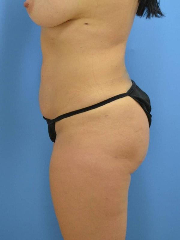Brazilian Butt Lift after at Clareo Plastic Surgery in Newton, MA