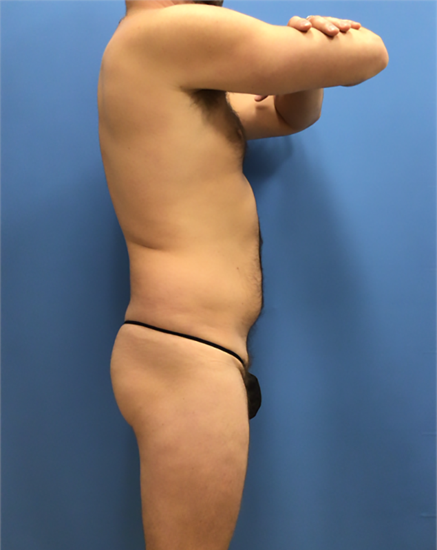 Brazilian Butt Lift before at Clareo Plastic Surgery in Chestnut Hill, MA
