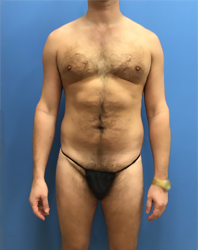 Liposuction before at Clareo Plastic Surgery in Newton, MA