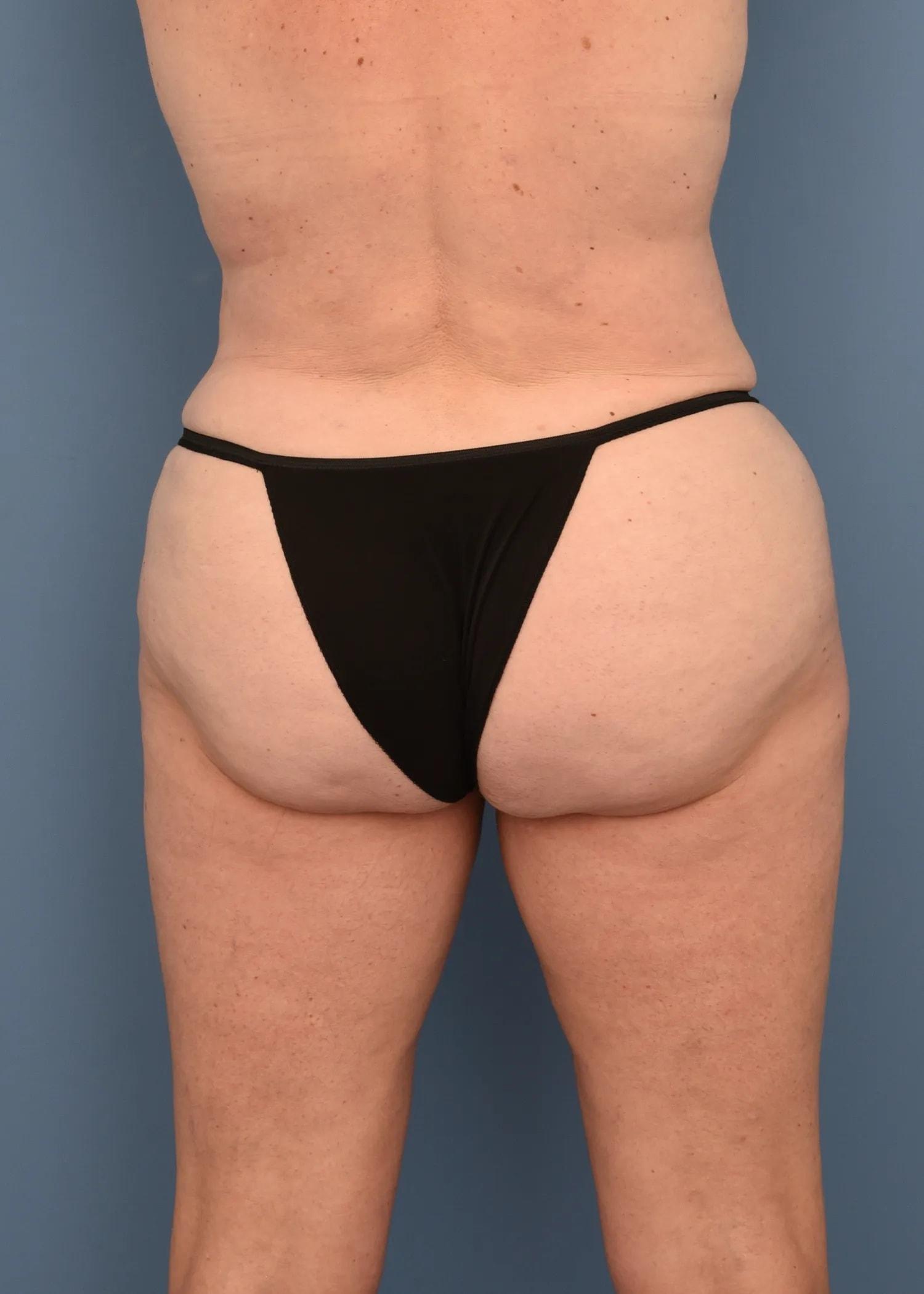 Gayoso Plastic Surgery liposuction after — St. Petersburg, FL