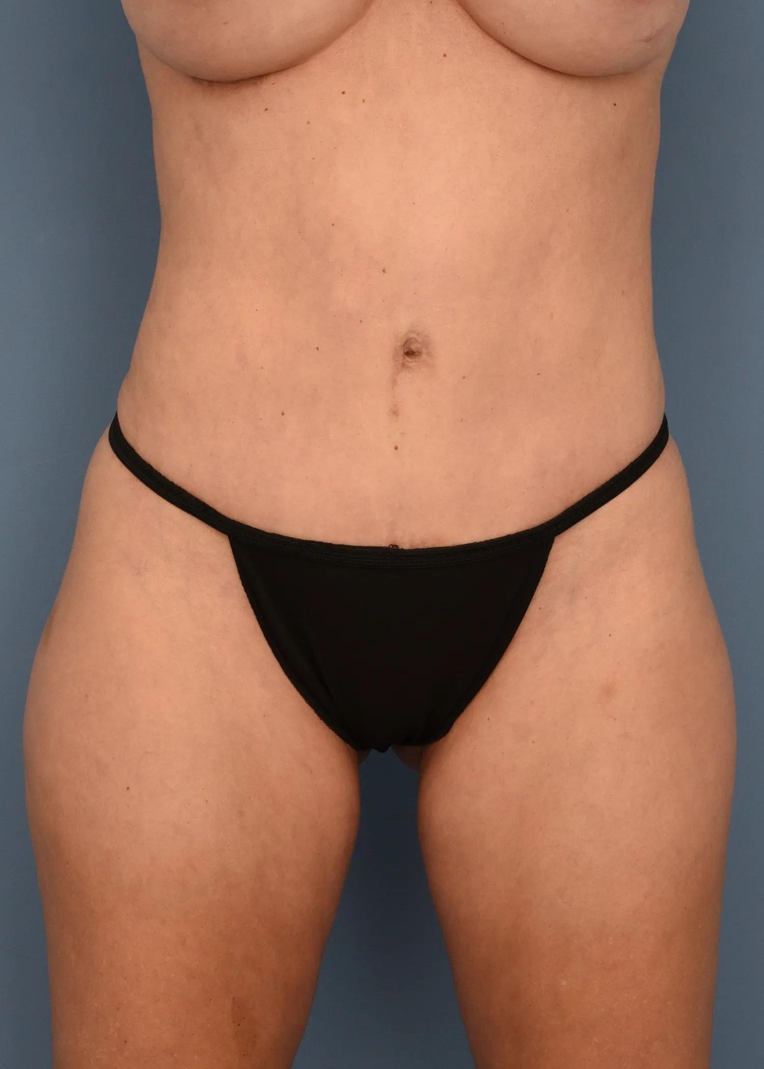 Gayoso Plastic Surgery tummy tuck after — St. Petersburg, FL