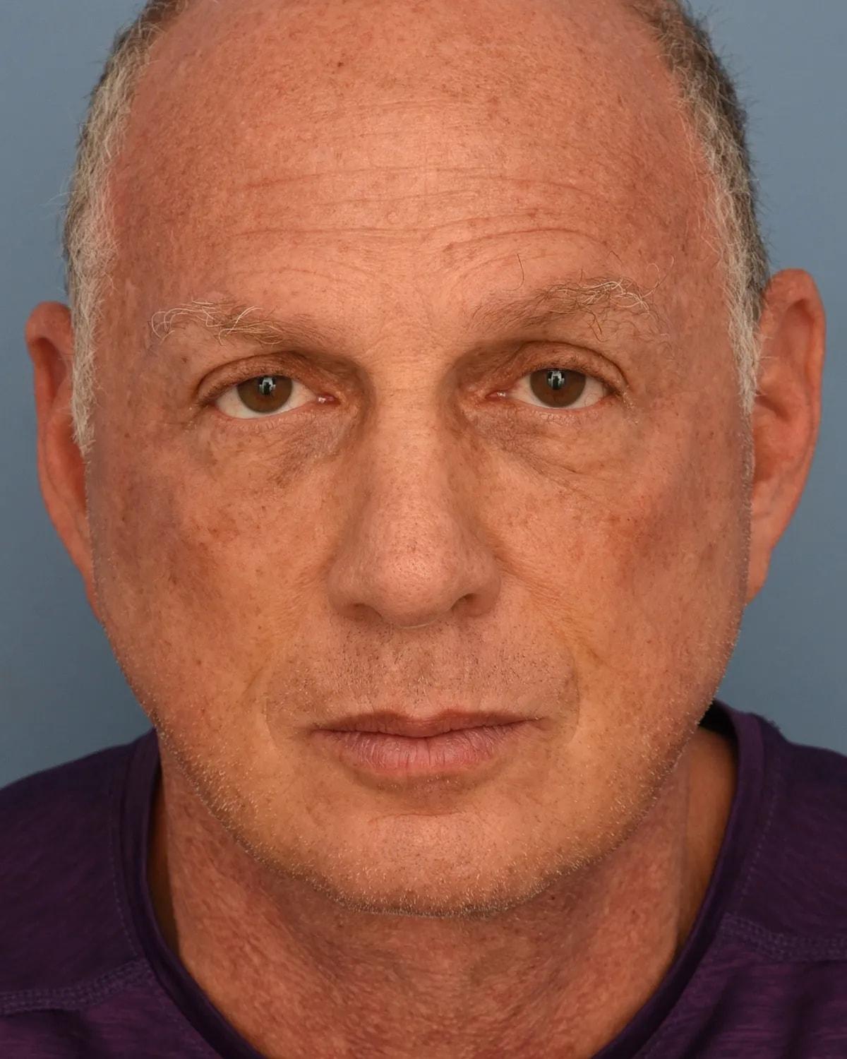 Gayoso Plastic Surgery facelift after — St. Petersburg, FL