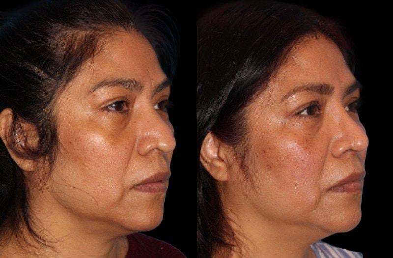 Paul P. Daraei, MD rhinoplasty result — Alpharetta, GA
