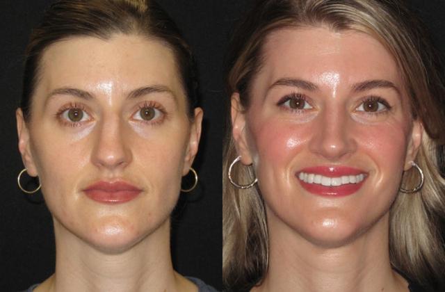 Rhinoplasty result at Paul P. Daraei, MD in Alpharetta, GA