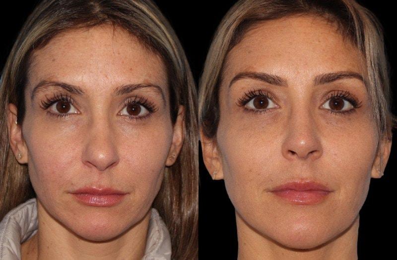 Paul P. Daraei, MD rhinoplasty result — Alpharetta, GA