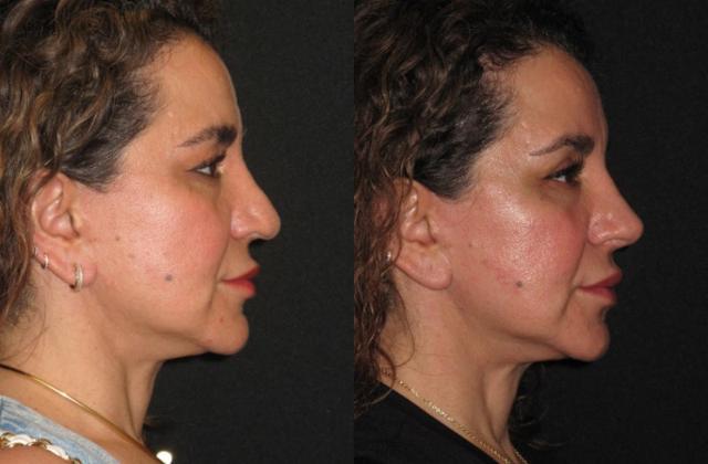 Rhinoplasty result at Paul P. Daraei, MD in Alpharetta, GA