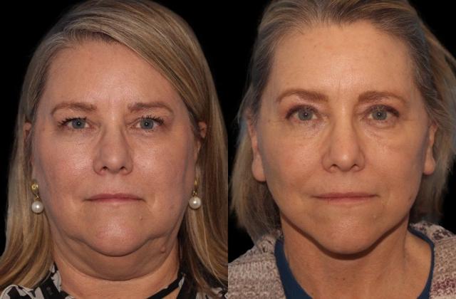 Blepharoplasty result at Paul P. Daraei, MD in Alpharetta, GA