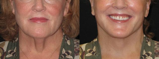 Deep Plane Facelift result at Paul P. Daraei, MD in Alpharetta, GA