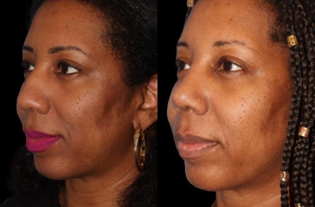 Rhinoplasty result at Paul P. Daraei, MD in Alpharetta, GA