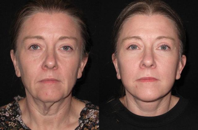 Neck Lift result at Paul P. Daraei, MD in Alpharetta, GA
