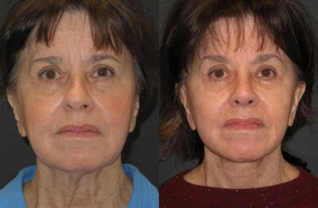 Blepharoplasty result at Paul P. Daraei, MD in Alpharetta, GA