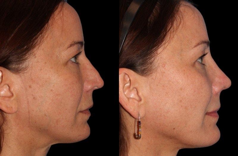 Paul P. Daraei, MD rhinoplasty result — Alpharetta, GA