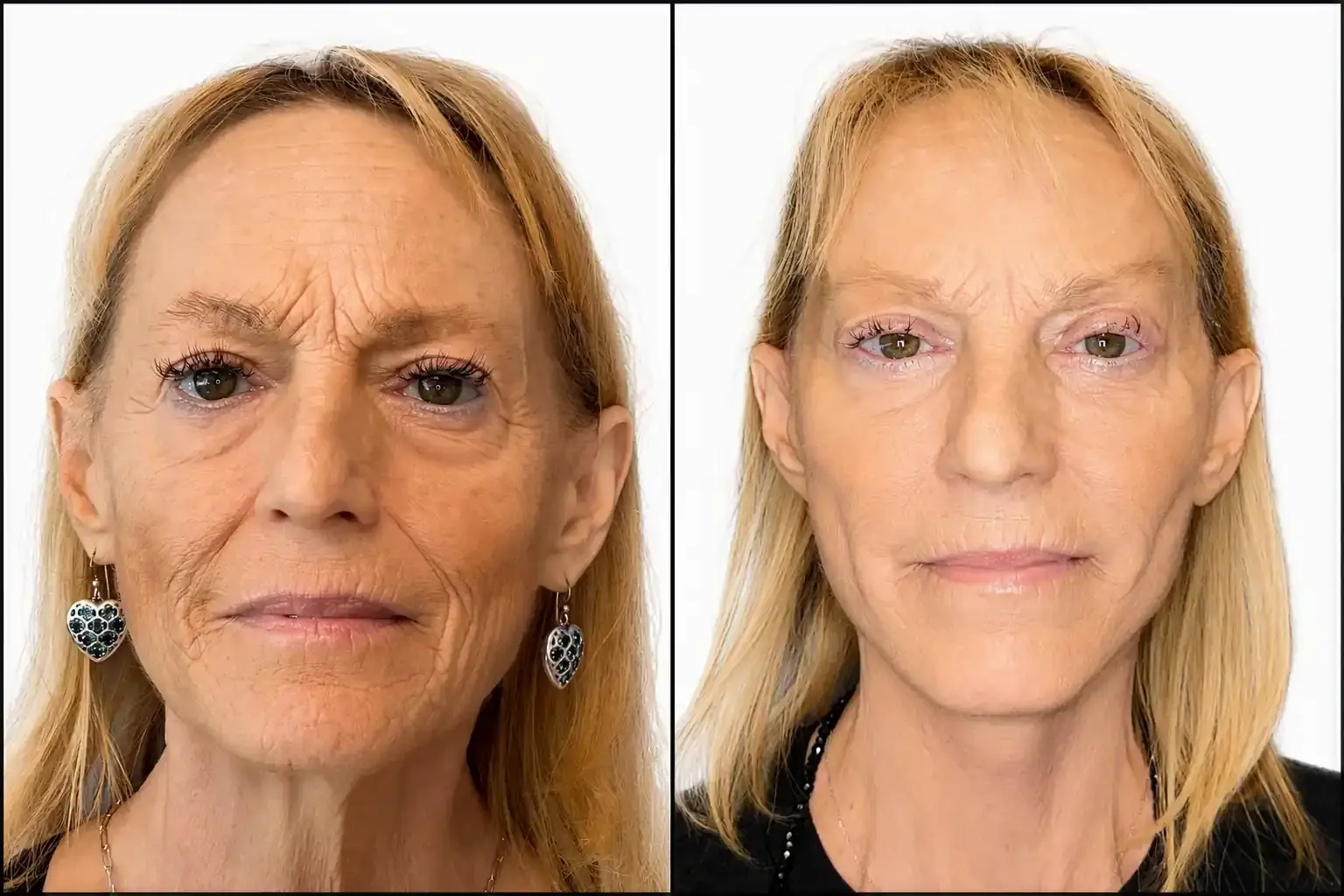 Miami Center for Plastic Surgery facelift result — Miami Beach, FL
