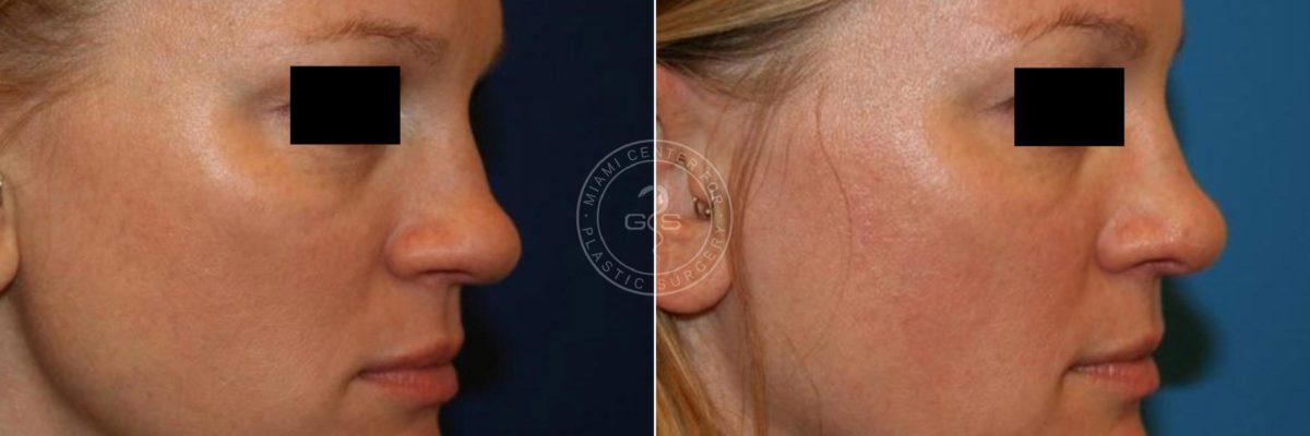 Miami Center for Plastic Surgery rhinoplasty result — Miami, FL