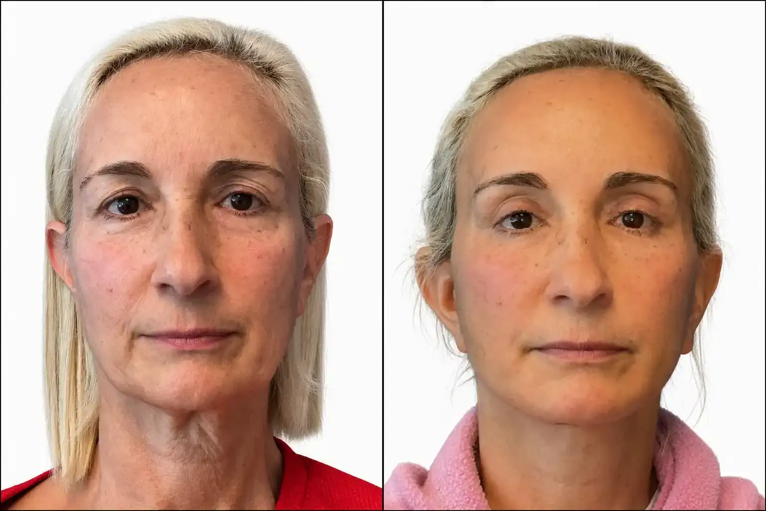 Miami Center for Plastic Surgery facelift result — Miami Beach, FL