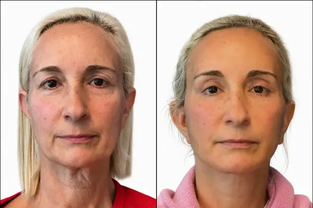 Mini Facelift result at Miami Center for Plastic Surgery in Miami Beach, FL