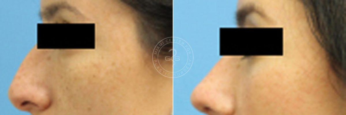 Miami Center for Plastic Surgery rhinoplasty result — Miami, FL